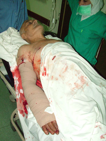 Eighty year old latest victim of cluster bomb explosion 
