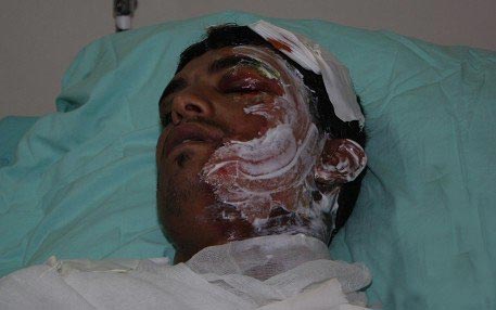 “Israelis” Beat, Pour Boiling Water on Palestinian Worker
