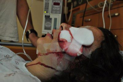 Emily Henochowicz US Peace Activist Loses Eye in Peaceful Protest against Flotilla Attack
