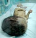 New Birth Defects Seen in Gaza Due to  “Israeli” Weapons