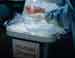“Israeli” at Heart of Kosovo Organ Trafficking Scandal