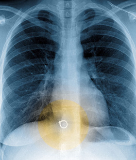 ring inside thief's stomach