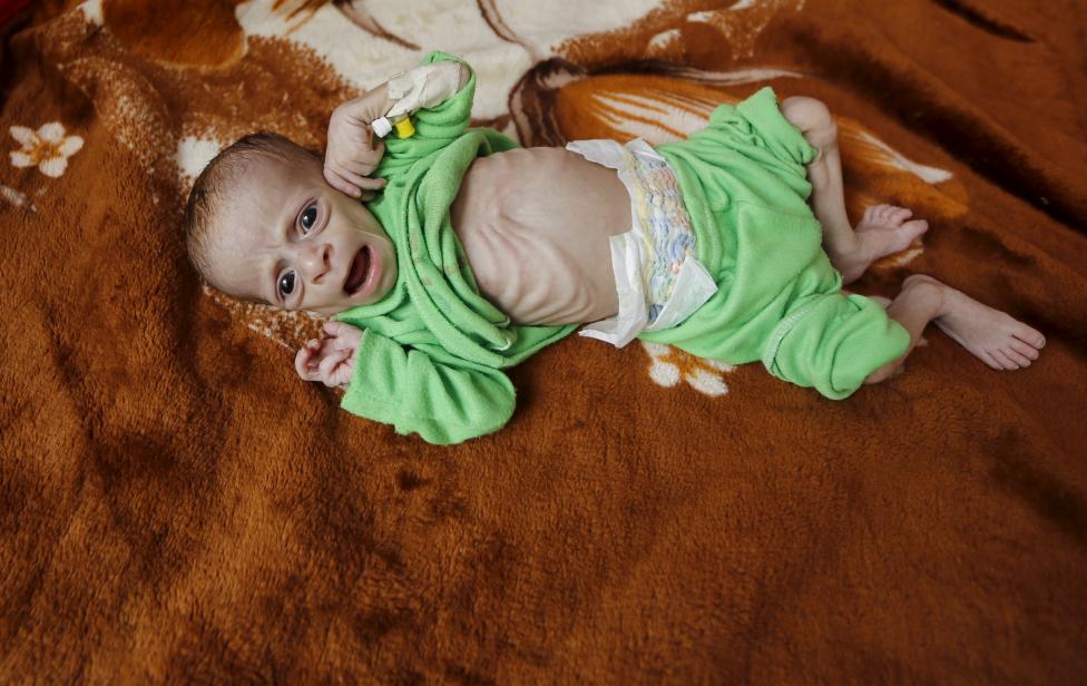  Merciless Saudi Aggression: Going Hungry in Yemen