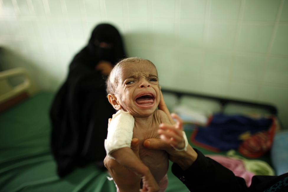  Merciless Saudi Aggression: Going Hungry in Yemen