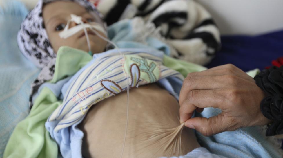  Merciless Saudi Aggression: Going Hungry in Yemen