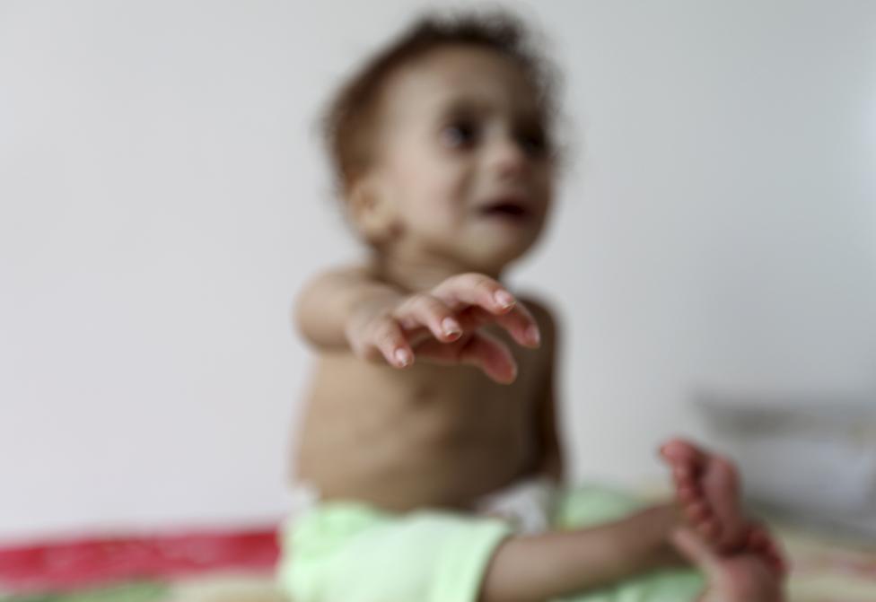  Merciless Saudi Aggression: Going Hungry in Yemen