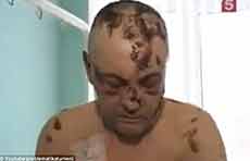 Flesh-Rotting ‘Krokodil’ Drug In US, ‘Frightens’ Arizona Medics