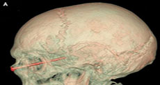 A Nail in the Eye, a Lucky Landscaper Left without a Scratch