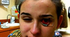 Teenager Kept Awake For Week to Stop Parasite Burrowing into Eyeball