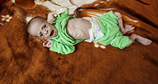 In a Yemen Hospital, Malnutrition Menaces Young Lives
