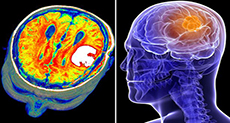 Deadly Brain Cancer Needs ’Fat’ to Grow