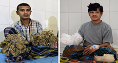 ‘Tree Man’ of Bangladesh ‘Cured’ after Undergoing 16 Surgeries