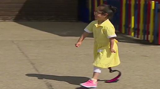 Seven-Yo Shows Friends Her New Prosthetic Leg, Their Reaction Is Beautiful