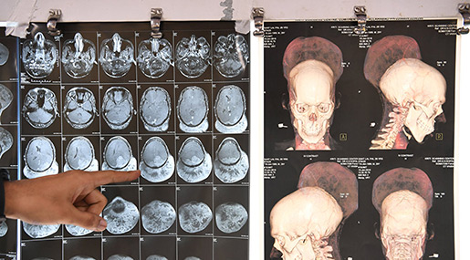 Indian Surgeons Remove Heaviest Brain Tumor!