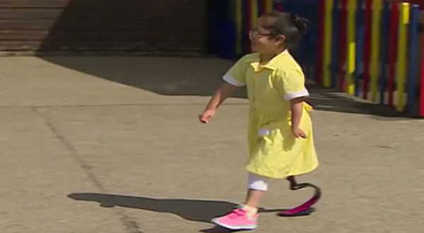 Seven-Yo Shows Friends Her New Prosthetic Leg, Their Reaction Is Beautiful Seven-Yo Shows Friends Her New Prosthetic Leg, Their Reaction Is Beautiful