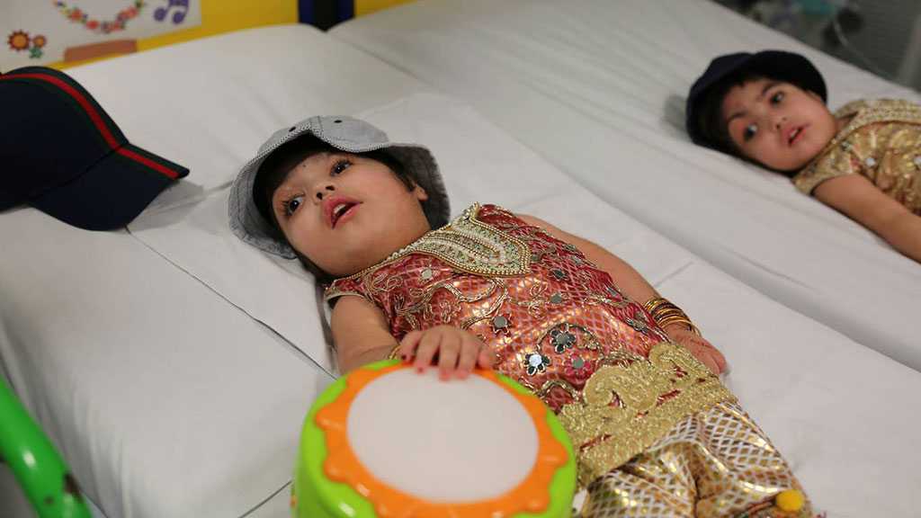 Conjoined Twins Joined At Skull Separated After 50 Hours of Operations