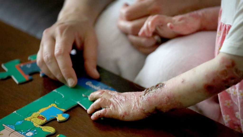 US’ Economic Terrorism Targets Iranian Children with Epidermolysis Bullosa