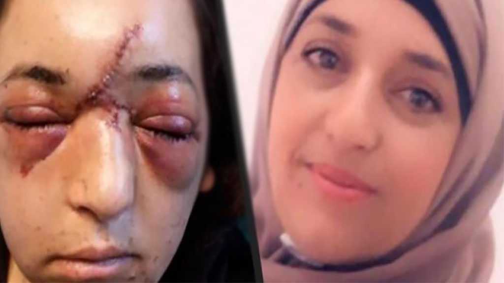 ‘Israeli’ Soldiers Broke Her Face, Skull As She Was Protecting Her Kid from Detention