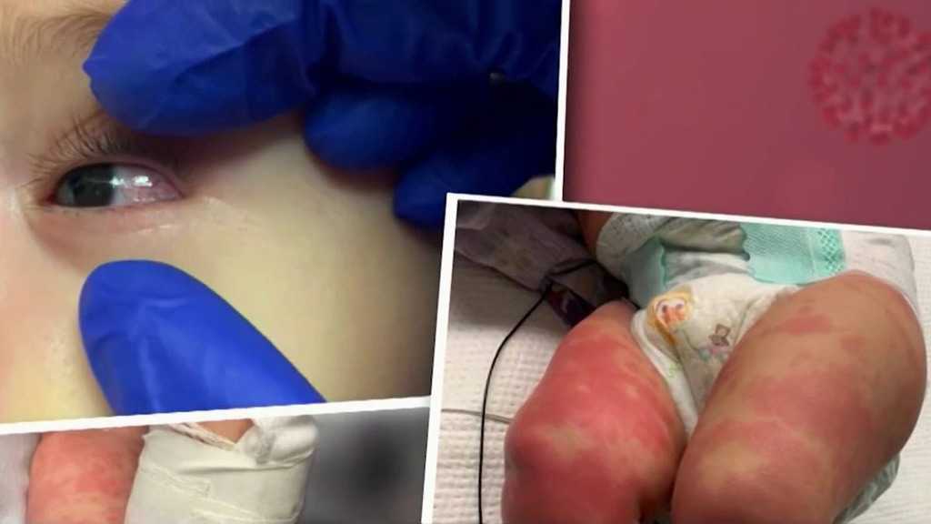 Dozen NYC Children Hospitalized with Coronavirus-linked Inflammatory Syndrome