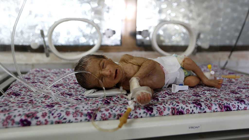 Yemeni Children Suffer Record Rates of Acute Malnutrition