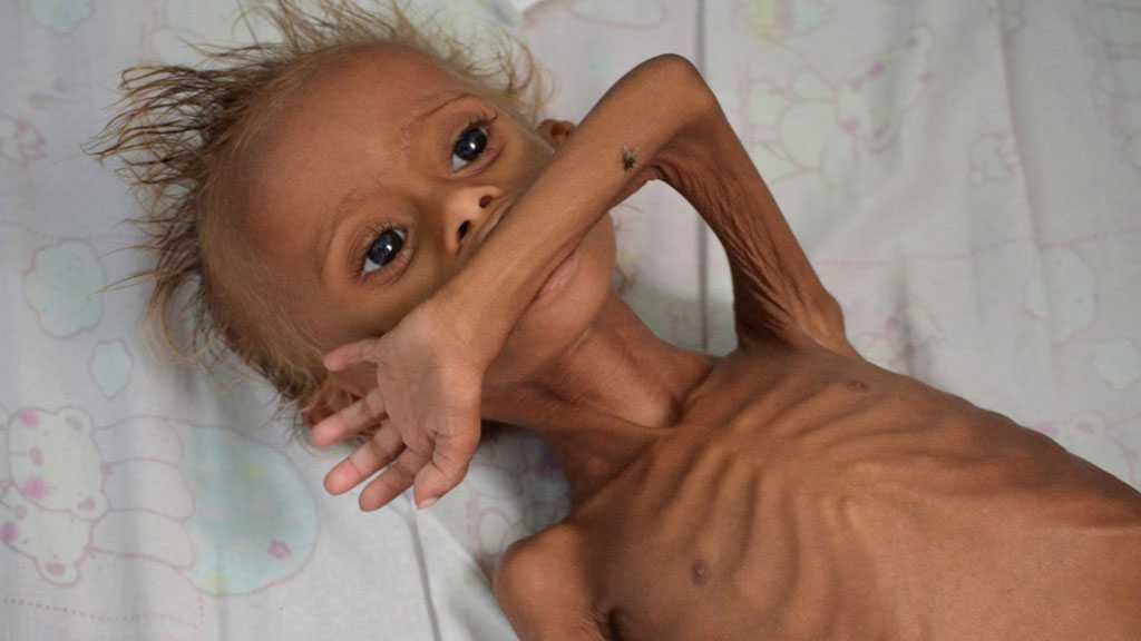 Yemen Faces World’s Worst Famine, Needs $3.85 Billion – UN Warns