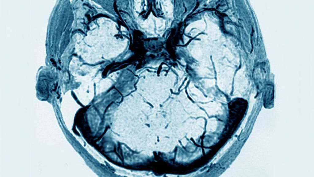 Researchers: AstraZeneca Vaccine Can Cause Thrombosis in Brain in ‘Rare’ Cases