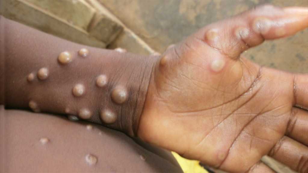Texas Resident Hospitalized with Viral Monkeypox Infection, CDC Says No Reason for Alarm