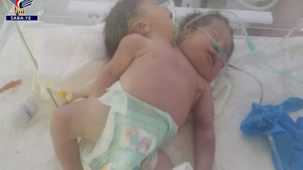 #OpenSanaaAirport: Yemeni Conjoined Twins Die Due to Airport Closure, UN Negligence