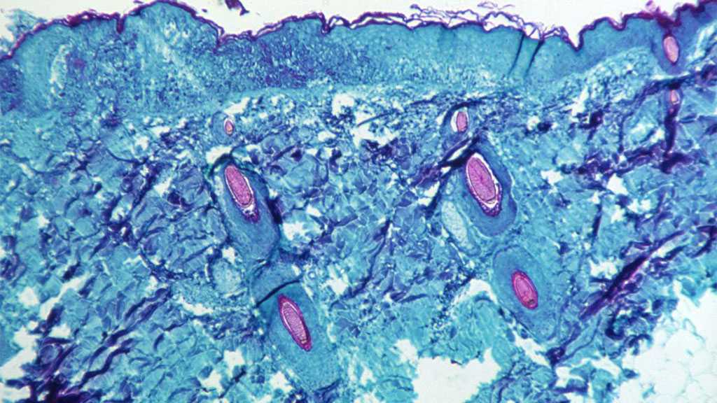 WHO Calls Emergency Meeting after Europe’s Monkeypox Cases Cross 100