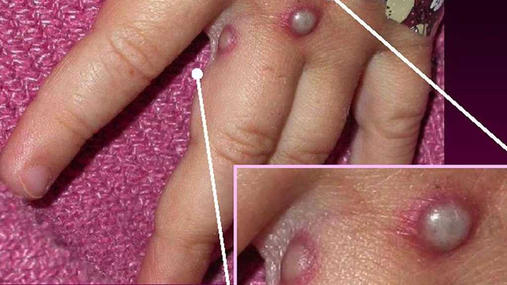 First Monkeypox Quarantine Ordered in Belgium