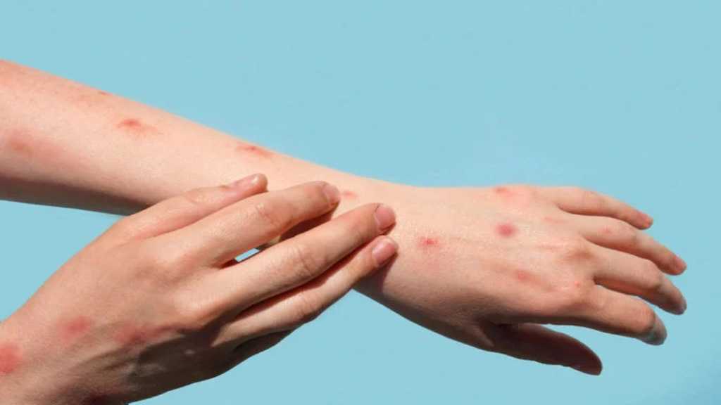 Lebanon’s Health Ministry Confirms Four Cases of Monkeypox Since June