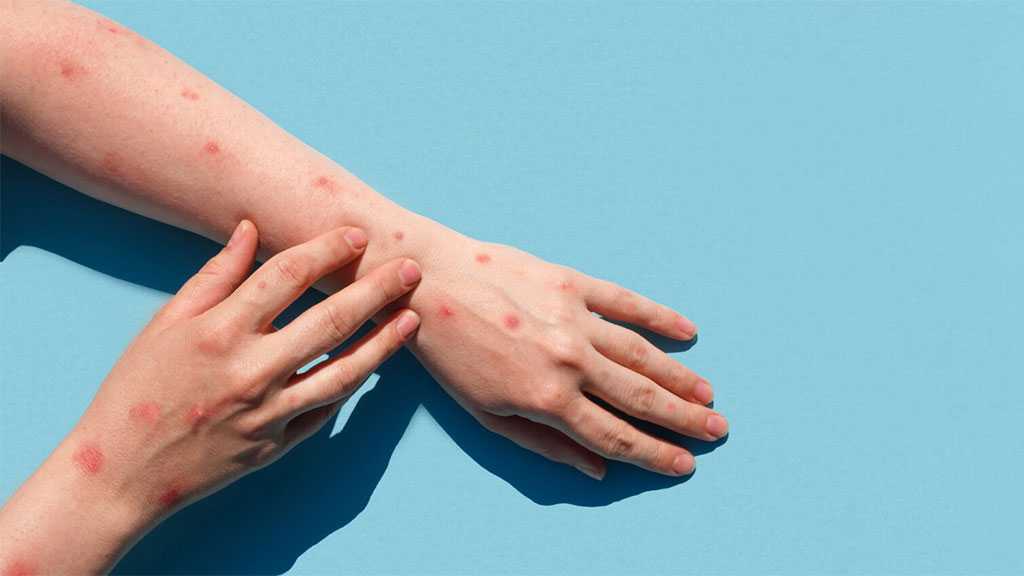 Over 10k Cases of Monkeypox Reported in US
