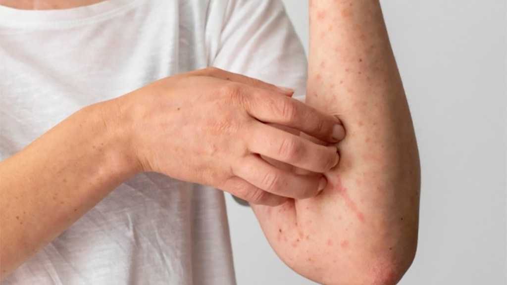Romania Declares Measles Epidemic